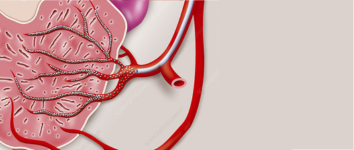 Stroke Treatment